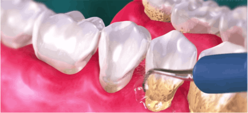 Periodoncia