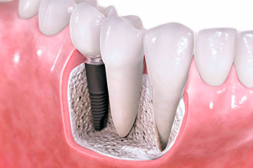 Implante Dental